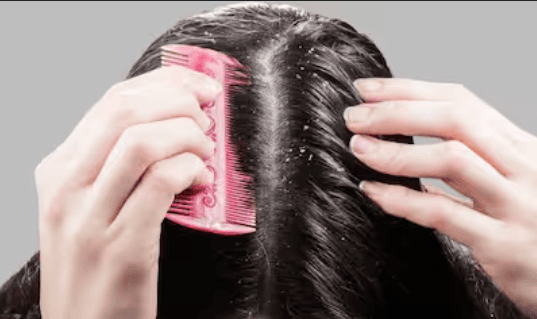 Get Rid Of Dandruff With This Simple Hack